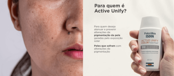 mulher com melasma fazendo tratamento com o protetor solar clareador ISDIN 99